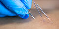 Dry needling - plus